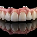 The Impact of Stress Management on Dental Implant Success